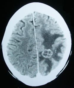 סריקת CT של גידול מוחי